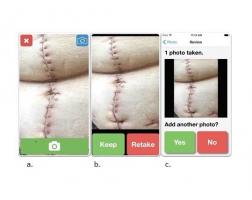 « WoundCheck » est une application iOS qui permet aux patients de transmettre des images de plaies chirurgicales quotidiennes de leur domicile pour un suivi de cicatrisation par un soignant ou un clinicien. 