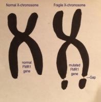 Chez les patients « X fragile », le gène FMR1, présent sur le chromosome X, est complètement désactivé