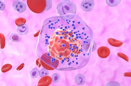 Cette étude suggère de nouvelles options thérapeutiques permettant de bloquer l'accumulation d'acides gras et les signaux immunosuppresseurs associés (Visuel Adobe Stock 1031587846)