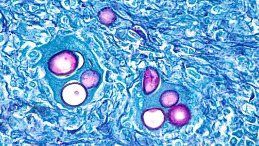 Que pourrait nous apprendre le cancer sur la tuberculose ? (Visuel Adobe Stock 333721267)