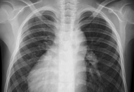 L’intelligence artificielle (IA) appliquée aux radiographies pourrait grandement faciliter le diagnostic complexe de l’achalasie (Visuel Adobe Stock 356170159)