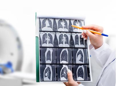 C’est une nette diminution de la mortalité par cancer du poumon, associée au dépistage, au diagnostic précoce et à la chirurgie (Visuel Adobe Stock 390810564)