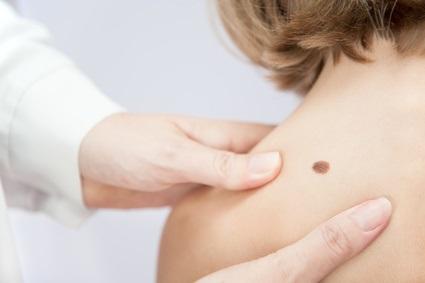La solution topique peut constituer une option efficace mais moins toxique et « mieux cicatrisante » pour les patients présentant cette forme de croissance cutanée non cancéreuse. 
