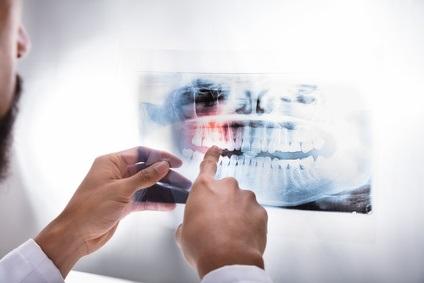 L'étude identifie des gènes et précisément, des variantes génétiques, qui déterminent la forme des dents (Visuel Fotolia 190684717)