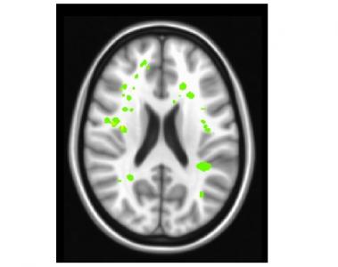 Les AVC silencieux (en vert clair sur visuel) ont aussi des effets débilitants sur la fonction exécutive, sur la capacité du cerveau à exécuter des tâches complexes nécessaires pour le maintien d'un travail ou la réussite scolaire. Les AVC silencieux (en vert clair sur visuel) ont aussi des effets débilitants sur la fonction exécutive, sur la capacité du cerveau à exécuter des tâches complexes nécessaires pour le maintien d'un travail ou la réussite scolaire.
