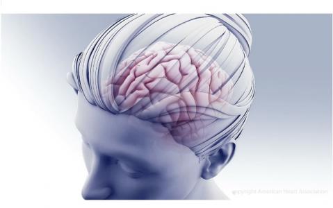 La thrombose des sinus veineux cérébraux (CVST) est caractérisée par la formation de caillots sanguins dans les veines du cerveau (Visuel AHA/ASA) La thrombose des sinus veineux cérébraux (CVST) est caractérisée par la formation de caillots sanguins dans les veines du cerveau (Visuel AHA/ASA)