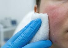 Le syndrome de peau sensible présente des mécanismes biologiques bien distincts de ceux de la rosacée (Visuel Adobe Stock 1975156726) Le syndrome de peau sensible présente des mécanismes biologiques bien distincts de ceux de la rosacée (Visuel Adobe Stock 1975156726)