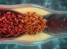 Cette technique dite de « click clotting » permet de créer des caillots sanguins artificiels en liant rapidement des globules rouges en un réseau gel-like, produisant des caillots 13 fois plus résistants et 4 fois plus adhésifs que les caillots naturels et biodégradables (Visuel Adobe Stock 2005350659) Cette technique dite de « click clotting » permet de créer des caillots sanguins artificiels en liant rapidement des globules rouges en un réseau gel-like, produisant des caillots 13 fois plus résistants et 4 fois plus adhésifs que les caillots naturels et biodégradables (Visuel Adobe Stock 2005350659)