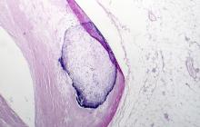 L'étude souligne ainsi l’importance d’une détection précoce de l’athérosclérose, même à niveau subclinique, pour le suivi de la santé globale (Visuel Adobe Stock 212636155).