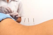 L'acupuncture a largement fait ses preuves contre la douleur, mais qu’en est-il des douleurs lombaires et pelviennes ressenties pendant la grossesse ?  (Visuel Adobe stock 394443748)