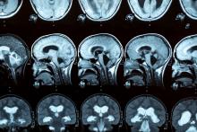 L'autisme n'est pas lié à un déclin cognitif accru avec l'âge (Visuel Adobe Stock 428612018)
