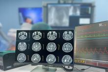 C'est une nouvelle stratégie de traitement de précision combinant profilage génétique et fonctionnel pour prédire comment le glioblastome va répondre au traitement (Visuel Adobe Stock 535437761)