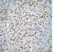 L’inhibiteur de point de contrôle va permettre ainsi au système immunitaire de lutter plus efficacement contre les cellules tumorales L’inhibiteur de point de contrôle va permettre ainsi au système immunitaire de lutter plus efficacement contre les cellules tumorales