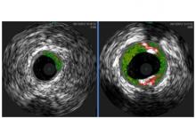 Ce n'est que récemment que l'allergène principal de la viande rouge, appelé galactose-α-1,3-galactose, ou alpha-Gal, un type de sucre complexe a été identifié. Ce n'est que récemment que l'allergène principal de la viande rouge, appelé galactose-α-1,3-galactose, ou alpha-Gal, un type de sucre complexe a été identifié.