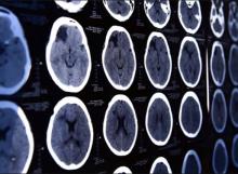 Grâce à ces progrès, les chances d’un patient ayant subi un AVC obtienne un bon résultat sont 2 à 3 fois meilleures qu'il y a 10 à 15 ans Grâce à ces progrès, les chances d’un patient ayant subi un AVC obtienne un bon résultat sont 2 à 3 fois meilleures qu'il y a 10 à 15 ans