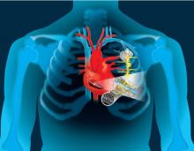 Exploiter la puissance du rythme cardiaque pour recharger son stimulateur ou « les batteries du coeur » Exploiter la puissance du rythme cardiaque pour recharger son stimulateur ou « les batteries du coeur »