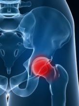 Un traitement prophylactique permet de réduire de 65% le risque de fracture chez les patients âgés sous cortisone
