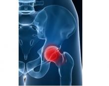 Dans certains cas ces marqueurs urinaires annoncent l’ostéolyse jusqu’à 6 ans avant le diagnostic. Dans certains cas ces marqueurs urinaires annoncent l’ostéolyse jusqu’à 6 ans avant le diagnostic.