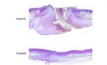 En incorporant un médicament inhibiteur de gènes dans un gel en vente libre, ces chercheurs parviennent à réduire de moitié le temps de cicatrisation