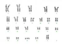 La trisomie 21, ou syndrome de Down, est une maladie génétique lourde caractérisée par l'addition d'un troisième chromosome 21. La trisomie 21, ou syndrome de Down, est une maladie génétique lourde caractérisée par l'addition d'un troisième chromosome 21.